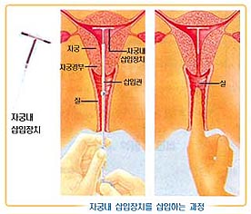 와이퀸산부인과 칼럼 [자궁내 삽입장치 2편] 의사선생님 추천 루프 고르는 법